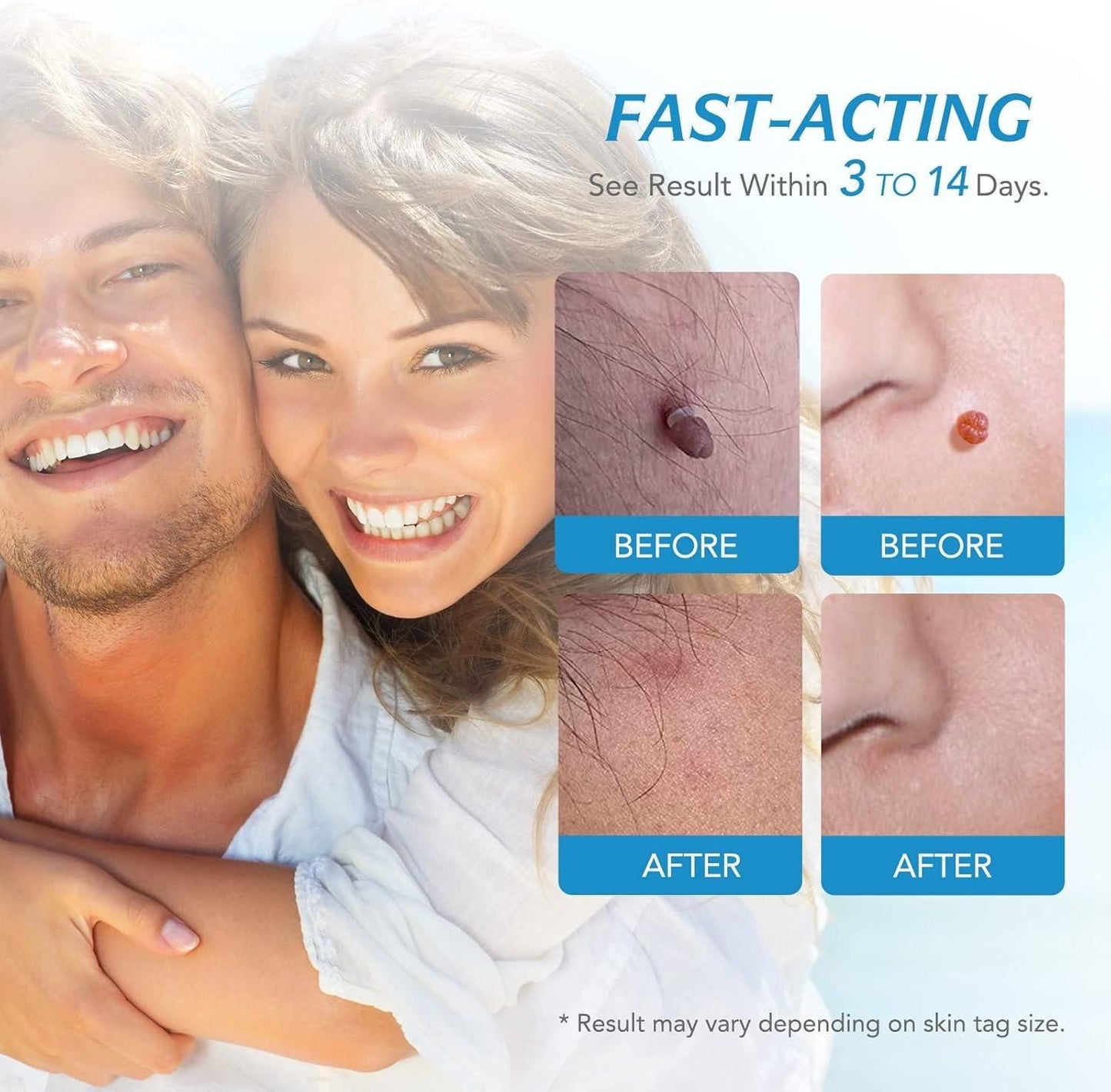 Skin Tag Remover - Now Remove Your Tags Painless