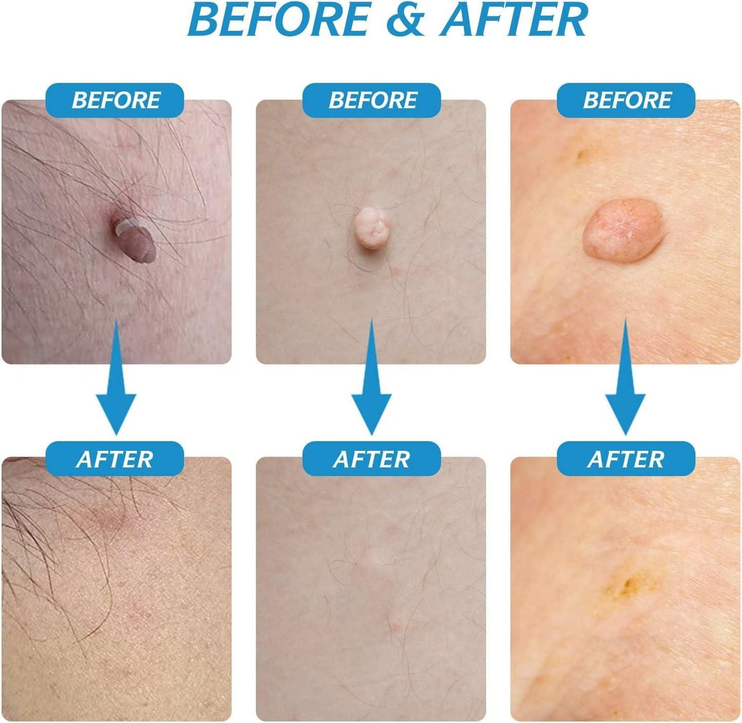 Skin Tag Remover - Now Remove Your Tags Painless